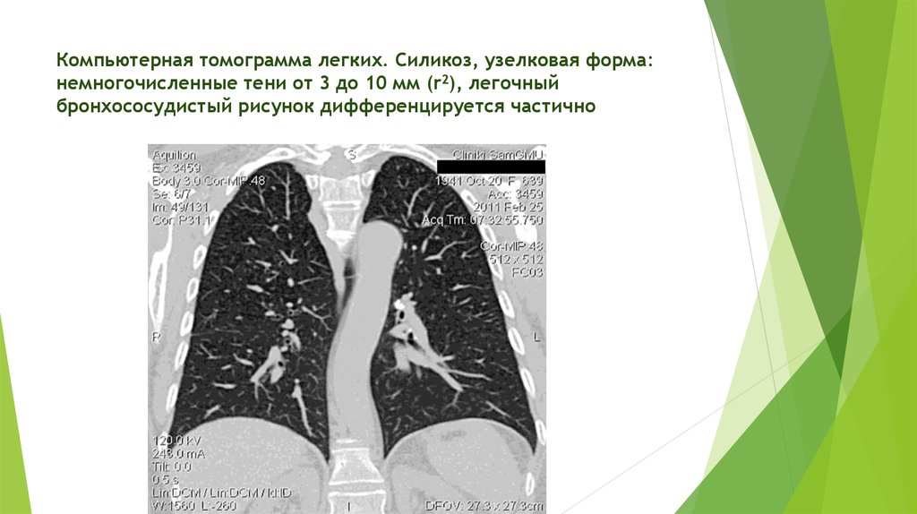 Бронхососудистый рисунок усилен что это значит на компьютерной томографии