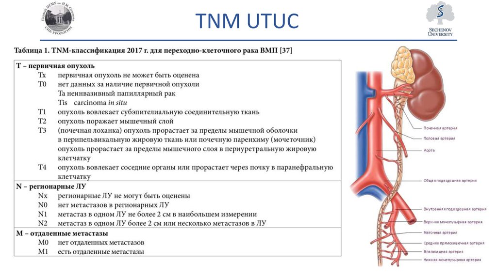 Стадии рака почки. Классификация TNM почки. Опухоль почки ТНМ. TNM опухоли почек и лоханки.