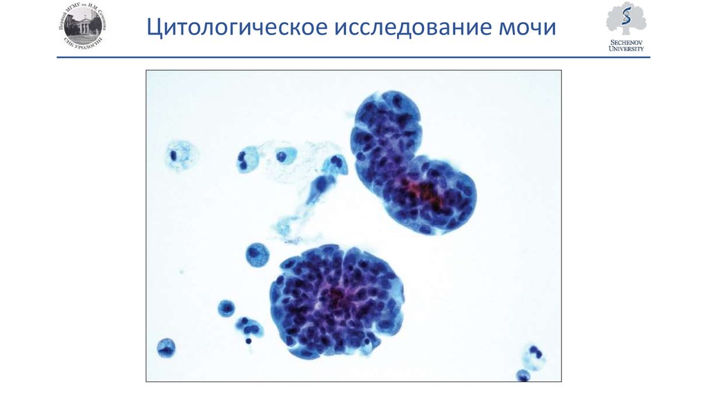 Цитологическое исследование. Цитология осадка мочи. Цитологическое исследование это исследование. Цитологическое исследование мочевого осадка. Цитологическое исследование моча.