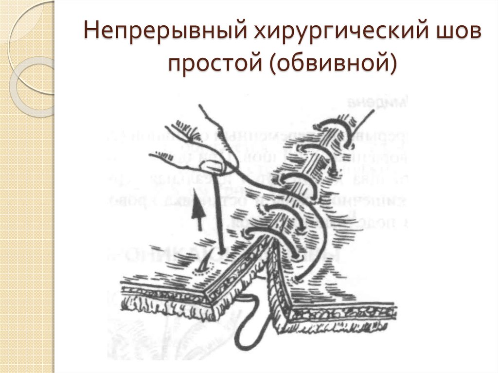 Ли шов. Непрерывный Скорняжный шов хирургия. Непрерывный обвивной шов. Непрерывный обвивной шов в хирургии. Обвивной непрерывный кетгутовый шов.