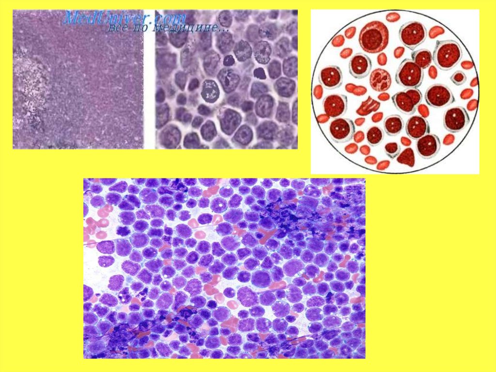 Вирус лейкемии. Острый лимфобластный лейкоз. Острый бластный лейкоз. Лимфобластный лейкоз в2 иммунологии. Острый лимфобластный лейкоз микропрепарат.