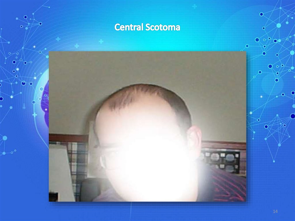 Central Scotoma