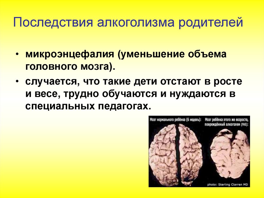 Последствия алкоголизма родителей. Мозг алкоголика и здорового. Как выглядит мозг алкоголика.