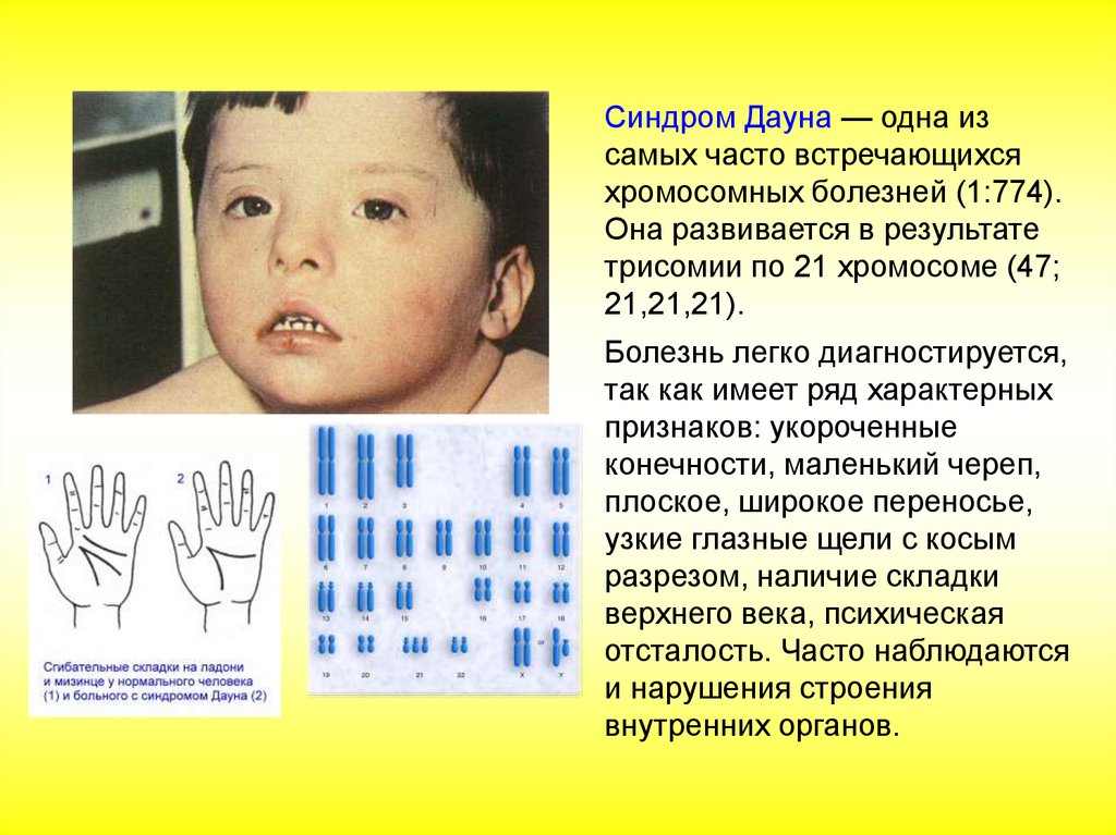 Заболевание болезнь дауна. Трисомии 21 (синдрома Дауна). Синдром трисомии хромосомы 8. Болезнь Дауна трисомия.