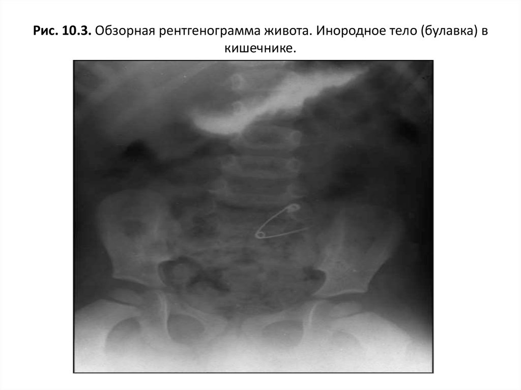 Инородное тело брюшной полости после операции