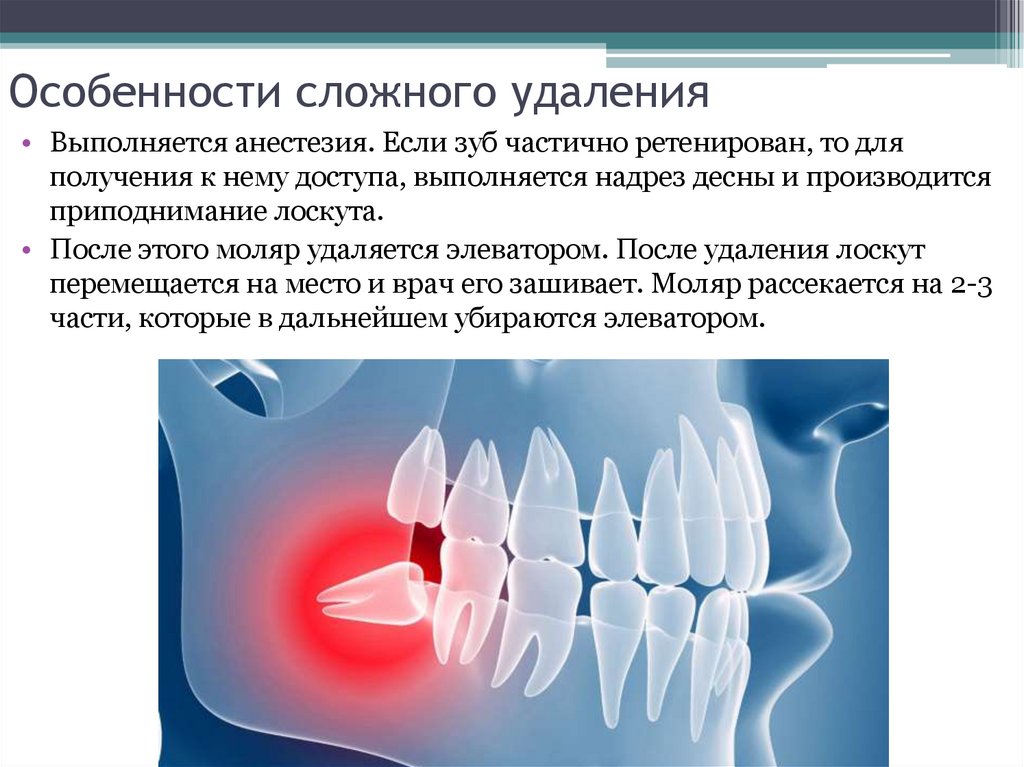 Осложнения при удалении зубов презентация