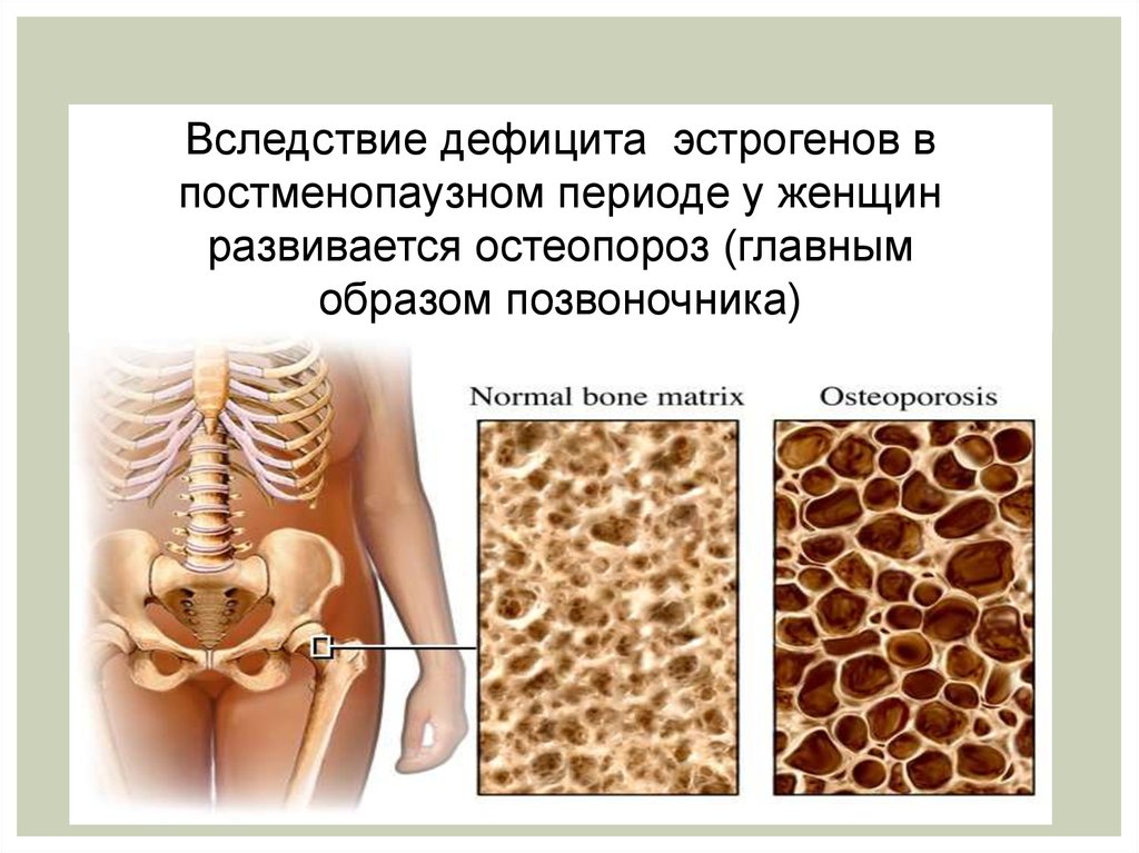 Постменопаузный остеопороз. Остеопороз у детей. Остеопороз картинки. Остеопороз картинки для буклета.