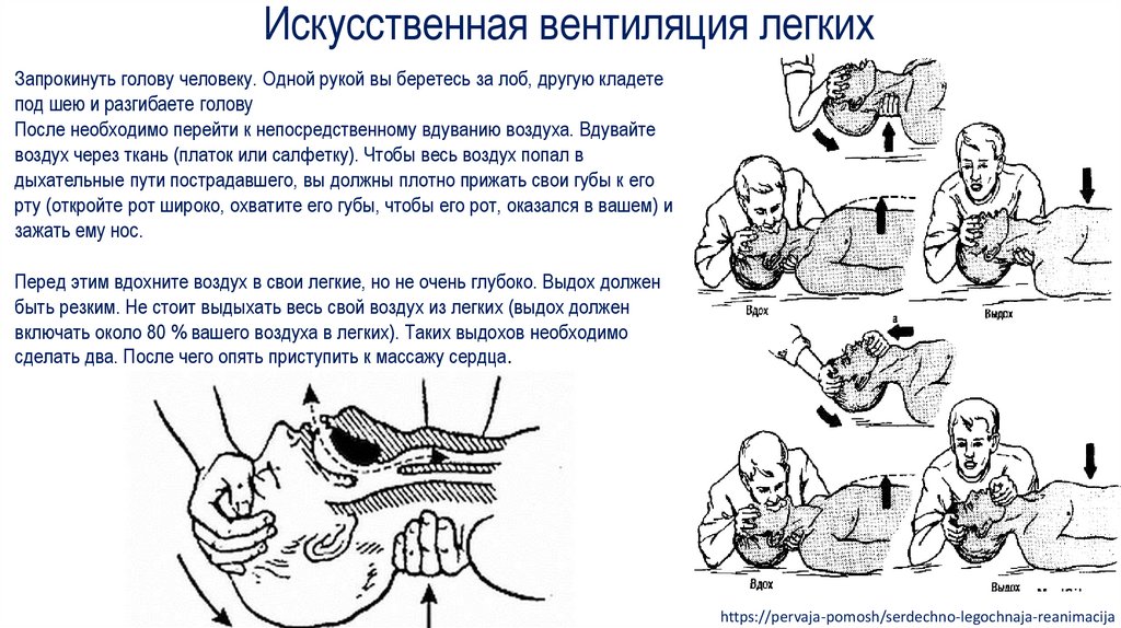 Искусственная вентиляция легких тесты с ответами