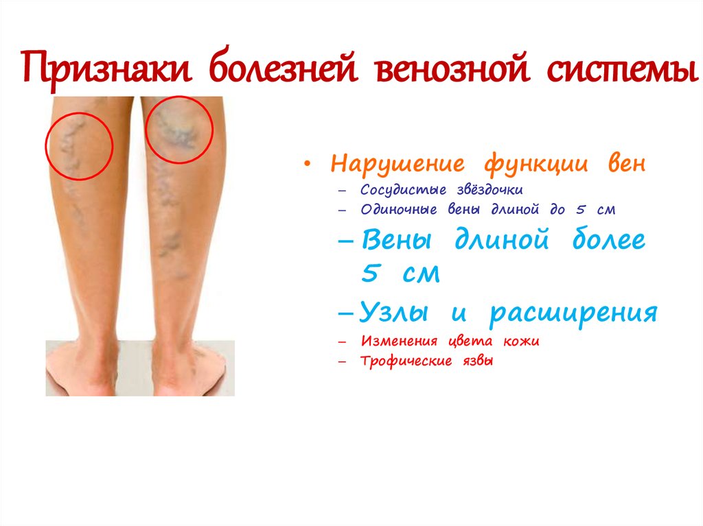 Признаки болезней венозной системы
