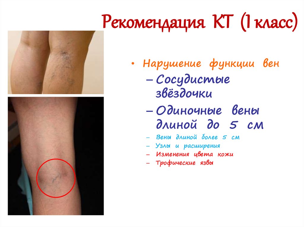 Рекомендация КТ (I класс)