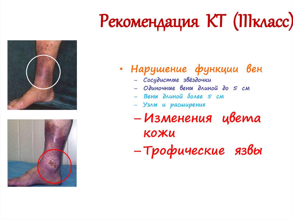 Рекомендация КТ (IIIкласс)