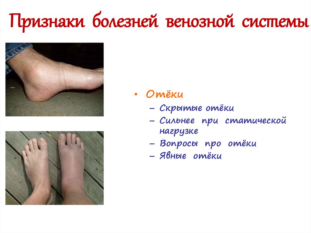 Признаки болезней венозной системы