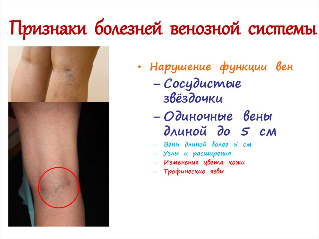 Признаки болезней венозной системы