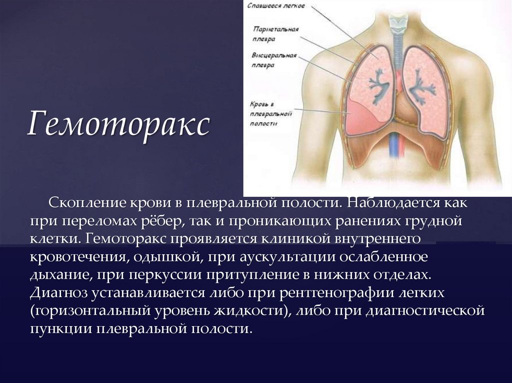 Гидроторакс карта смп