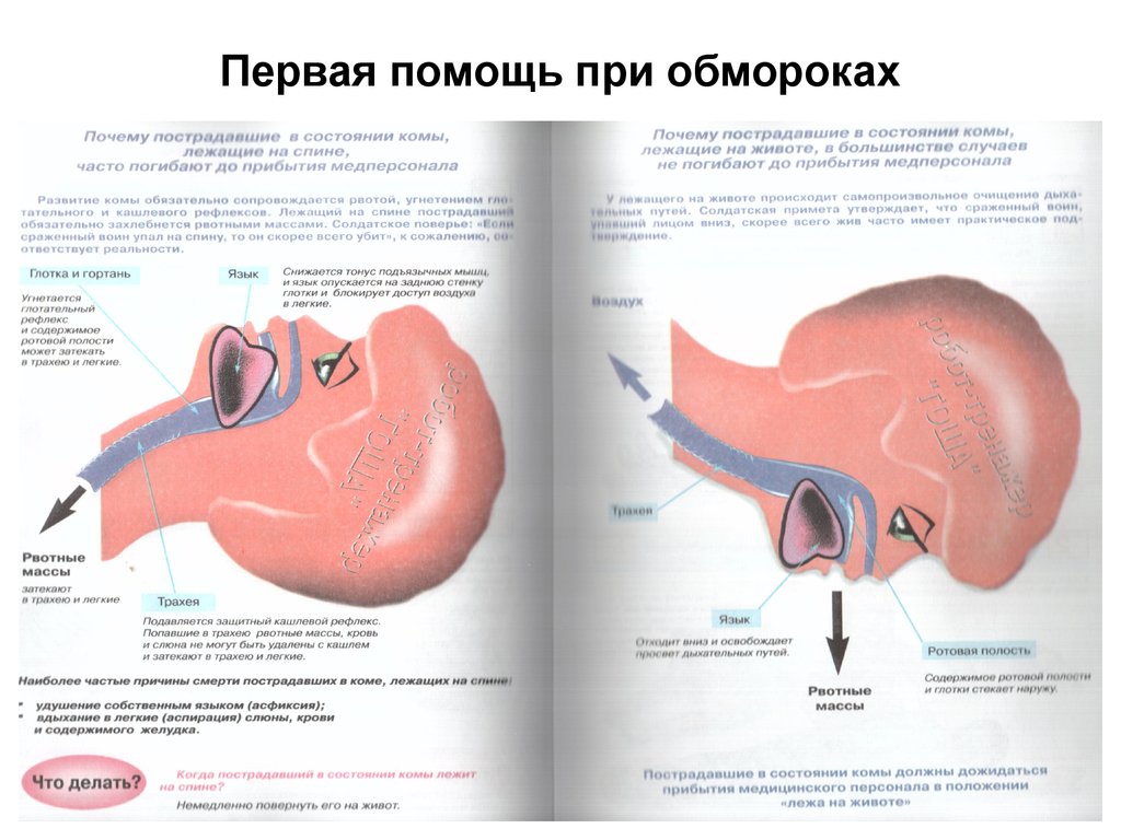 На рисунке 69 показано что происходит при западении языка