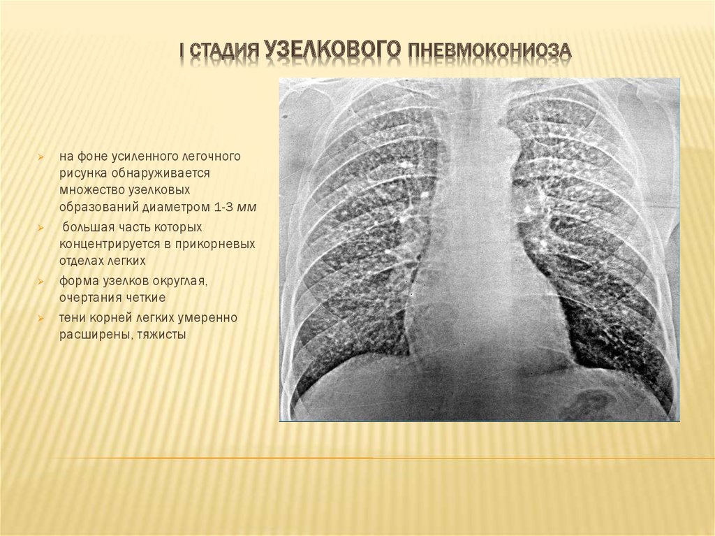 Прикорневой легочный рисунок. Пневмокониоз легких 2 стадия рентген. Пневмокониоз легких 1 стадия рентген. Узелковый пневмокониоз рентгенограмма. Узелковый пневмокониоз рентген.