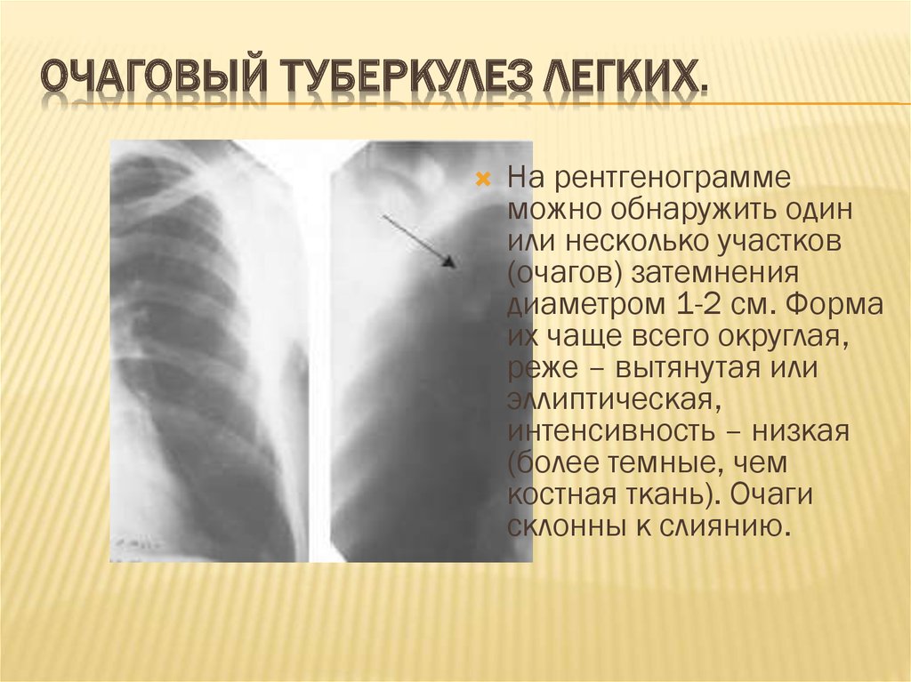 Округлыми формами в легком. Очаговый туберкулез рентген признаки. Фиброзно-очаговый туберкулез легких рентген. Рентгенологические признаки очагового туберкулеза легких. Очаговый туберкулез легких рентген признаки.