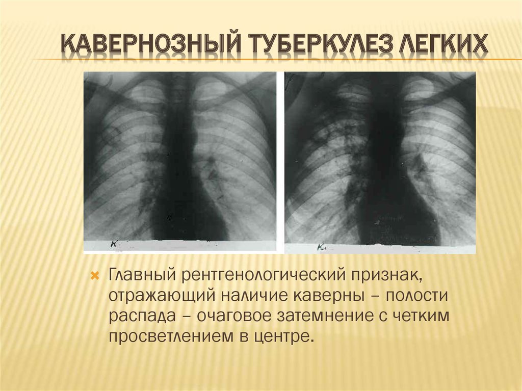 Легкие главная. Фиброзно-кавернозный туберкулез рентген. Каверна при туберкулезе на рентгене. Кавернозный туберкулез рентген. Туберкулезная каверна рентген.