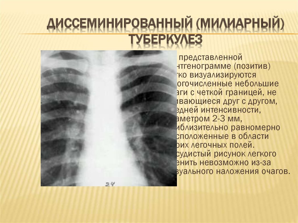 Диссеминированный туберкулез фаза инфильтрации. Подострый диссиминированный туберкулёз рентген. Хронический диссеминированный туберкулез рентген. Лимфогенно диссеминированный туберкулез рентген. Диссеминация туберкулеза на рентгене.