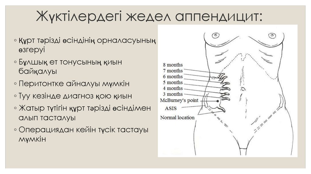 Жедел аппендицит