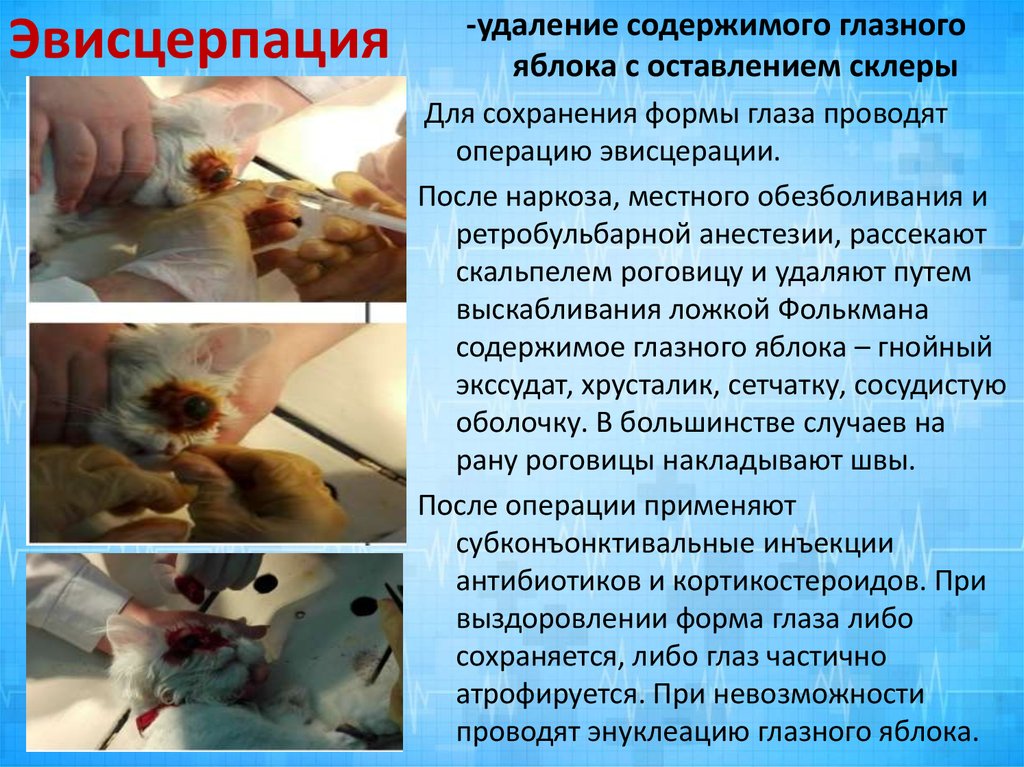 Эвисцерпация