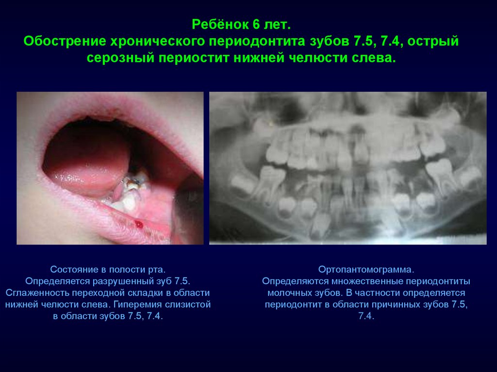 Периодонтит у ребенка фото