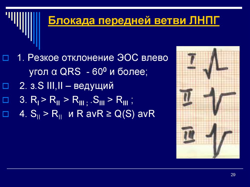 Отклонение эос влево. Блокада задней ветви ЛНПГ. Блокада передней ветви ЛНПГ. Блокада задней ветви левой ножки пучка Гиса. Блокада передней ветви левой ножки пучка Гиса.