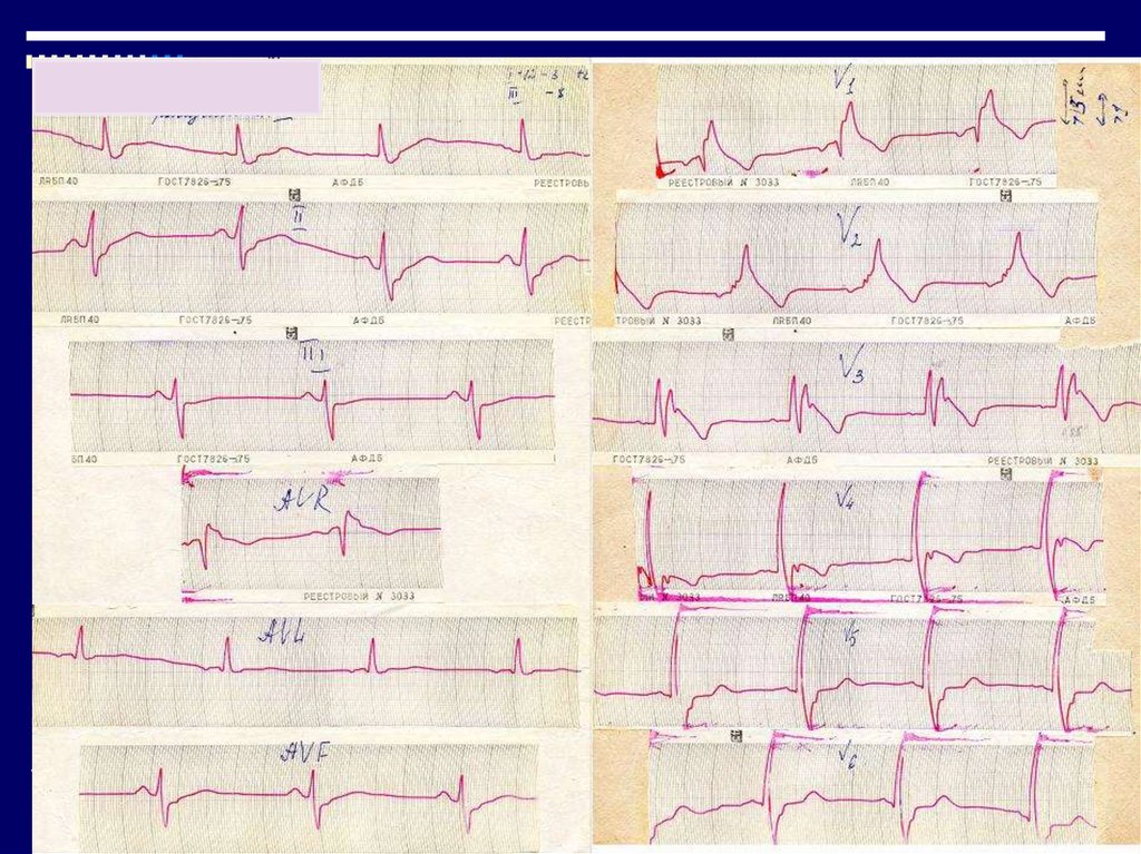 Нарушения на экг. Нарушение проводимости на ЭКГ. Нарушение внутрижелудочковой проводимости на ЭКГ. ЭКГ-диагностика нарушений проводимости.. Внутрижелудочковая блокада ЭКГ диагностика.