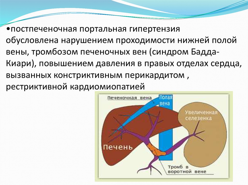 Синдром портальной гипертензии презентация