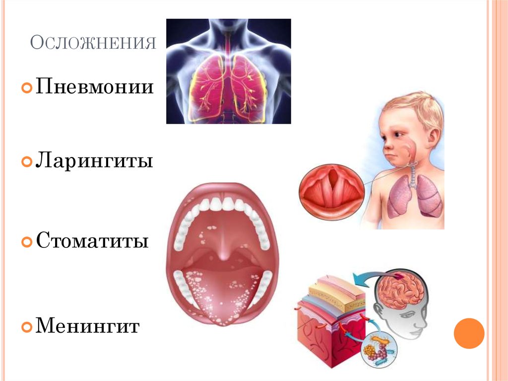 Осложнения кори картинки