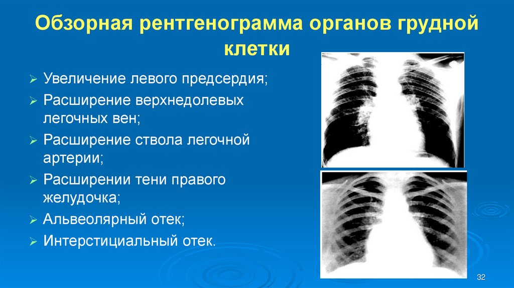 Обзорная рентгенограмма органов грудной клетки