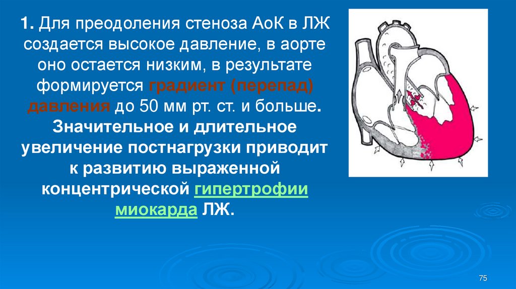 Аортальный градиент. Субаортальный стеноз аорты. Супрааортальный стеноз. Врожденный субаортальный стеноз. Мышечный субаортальный стеноз.