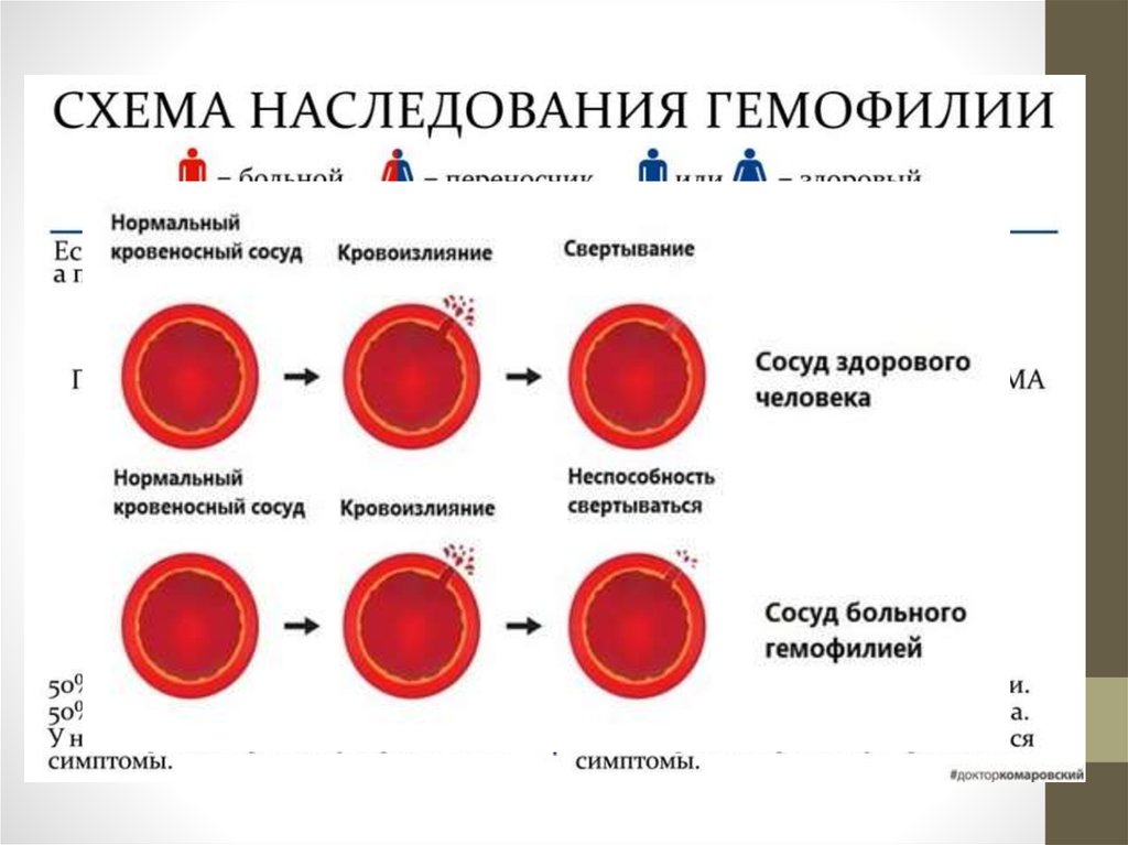 Гемофилия а и б презентация