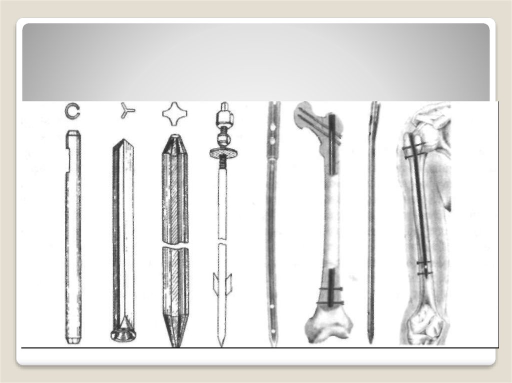 СТЕРЖНИ ДЛЯ ВНУТРИКОСТНОЙ ФИКСАЦИИ