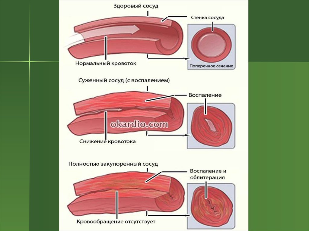 Нормальный сосуд. Эндартериит патогенез. Облитерация просвета артерий.