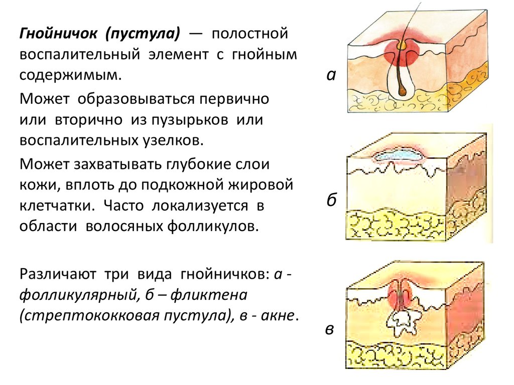 Первичный морфологический элемент пустула