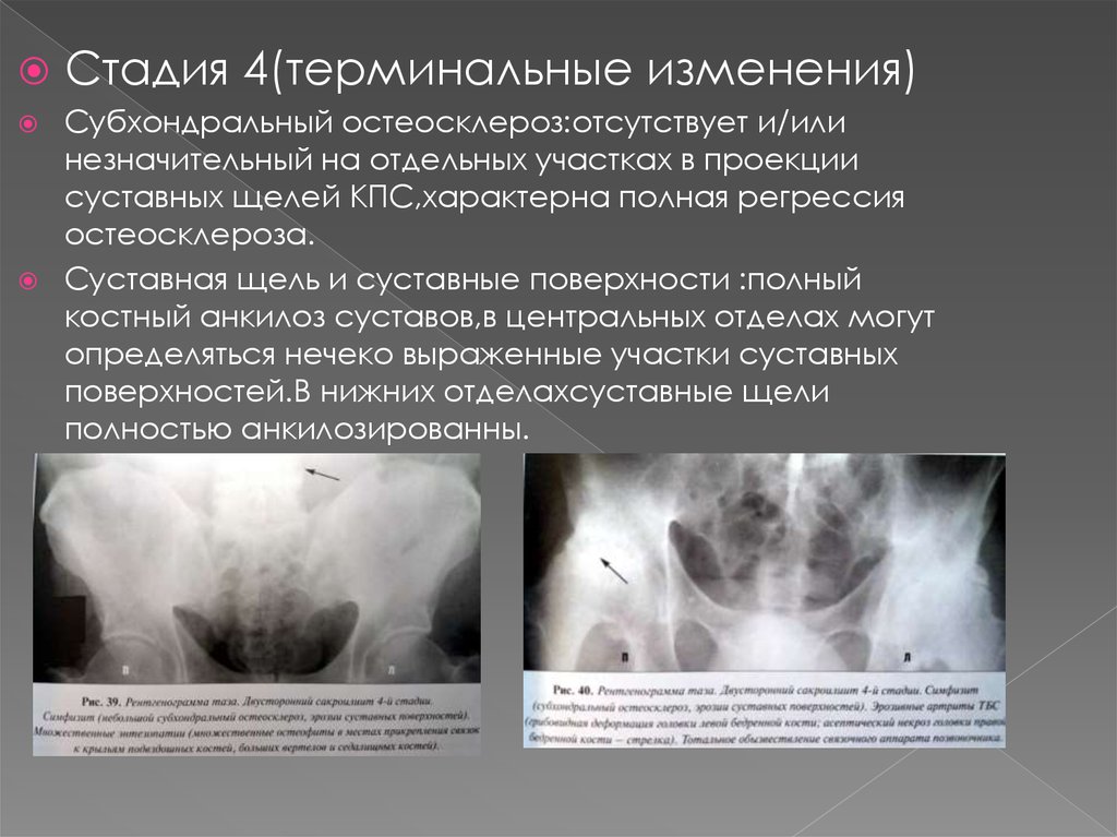 Рентгенологическая картина костного анкилоза внчс характеризуется