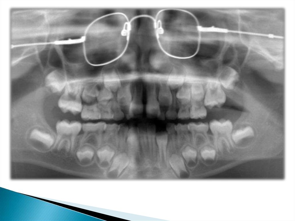 Панорамный снимок ребенка. Ортопантомограмма сменного прикуса. Сменный прикус рентген.
