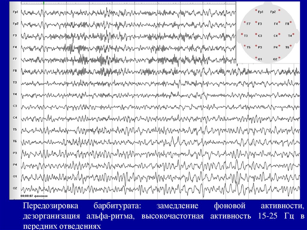 Фоновая активность. Дезорганизованный Альфа ритм на ЭЭГ что это. Дезорганизованный ритм Альфа активности на ЭЭГ. Дезорганизация ритма на ЭЭГ это. Основной ритм дезорганизован ЭЭГ что это.