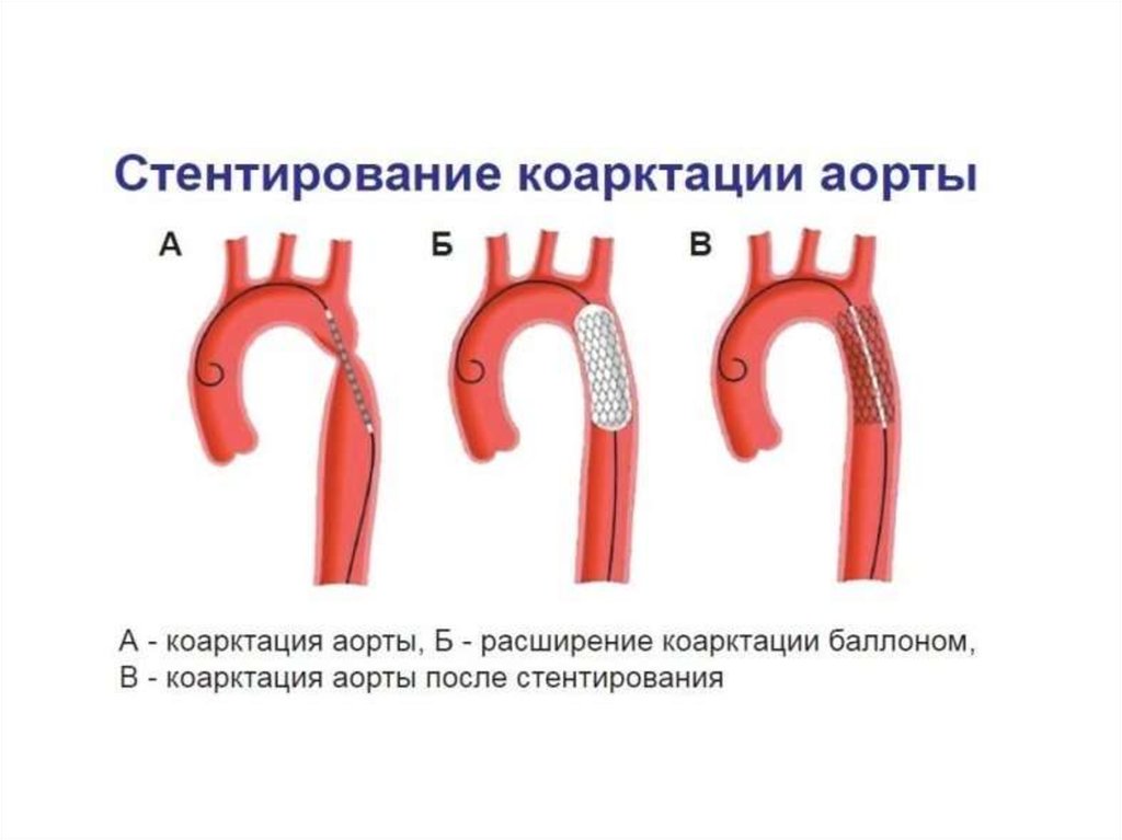 Коарктация аорты картинки