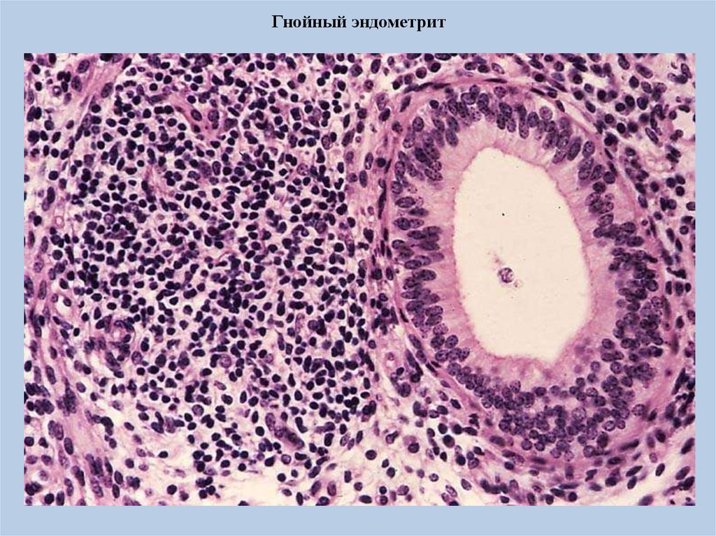 Послеродовой острый гнойно катаральный эндометрит. Гнойно послеродовой эндометрит микропрепарат. Острый эндометрит гистология. Септический Гнойный эндометрит. Гнойный метрит микропрепарат.