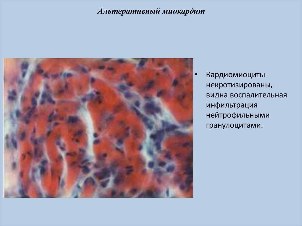 Опухоль с преобладанием паренхиматозной ткани