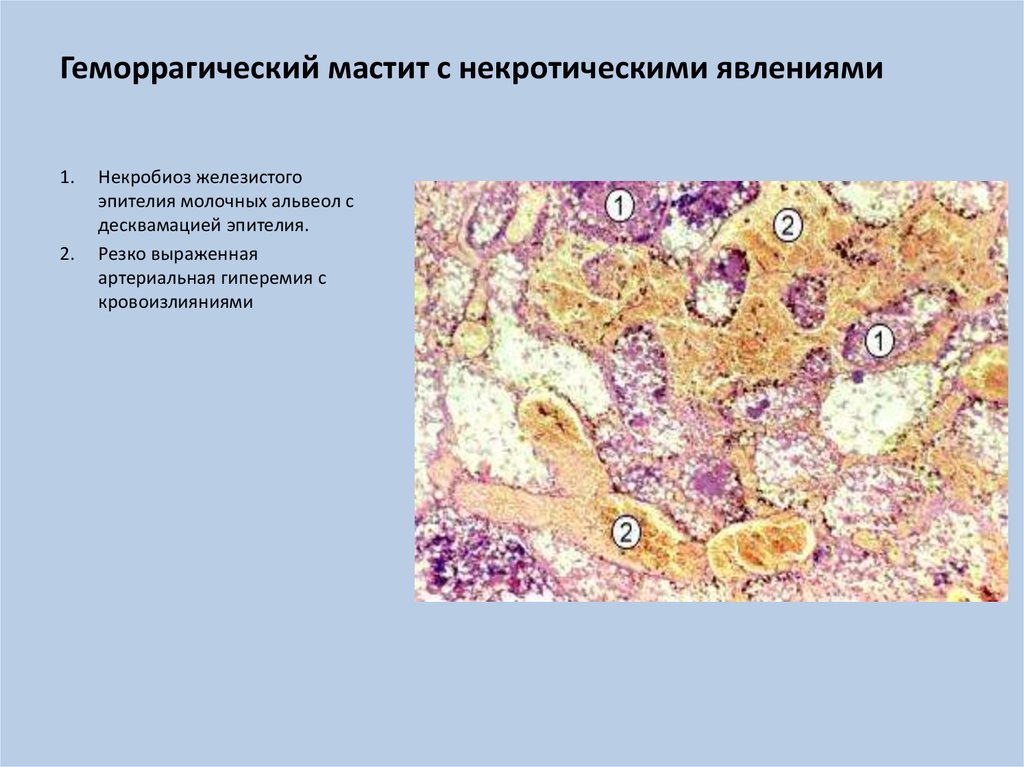 Острый мастит презентация