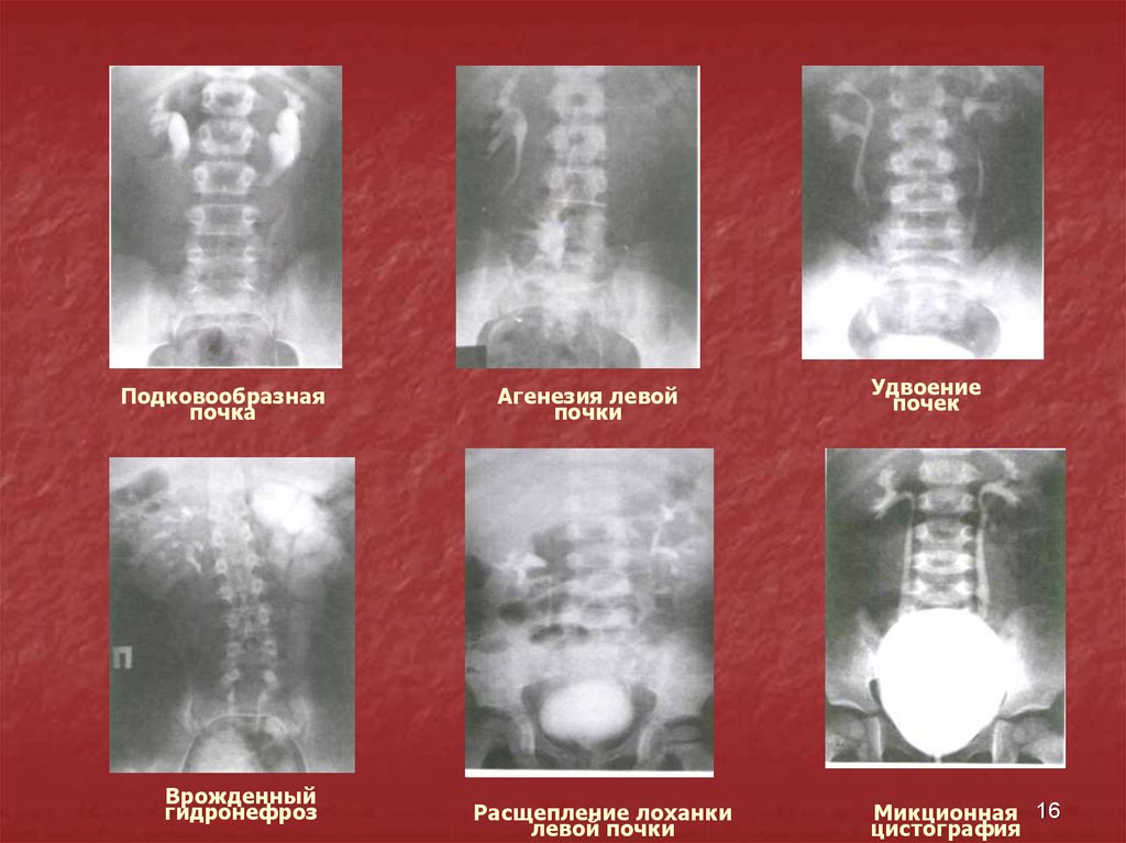 Агенезия это. Агенезия почки рентген. Агенезия почки односторонняя. Гидронефроз подковообразной почки.