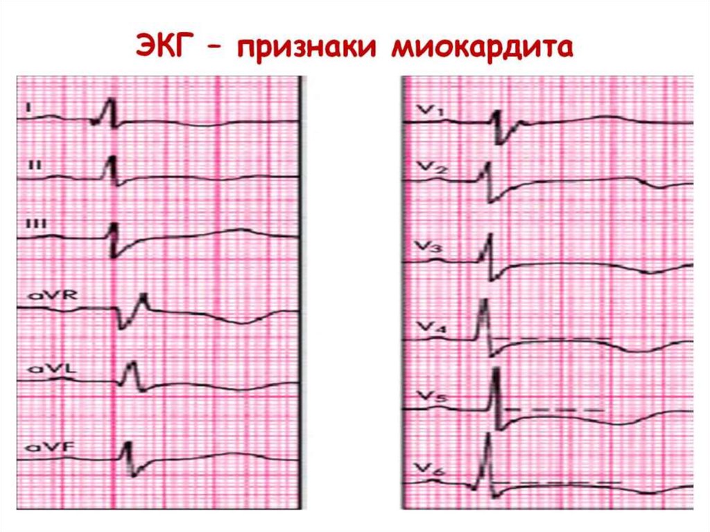 ЭКГ – признаки миокардита