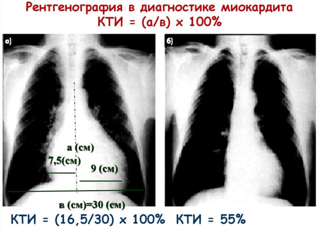 Рентгенография в диагностике миокардита КТИ = (а/в) х 100%