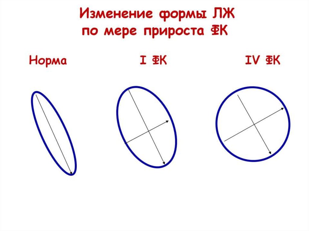 Изменение формы ЛЖ по мере прироста ФК Норма I ФК IV ФК