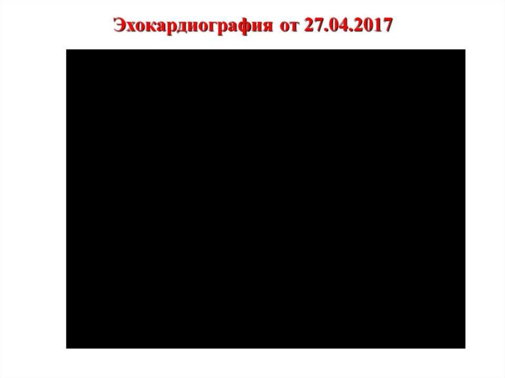 Эхокардиография от 27.04.2017