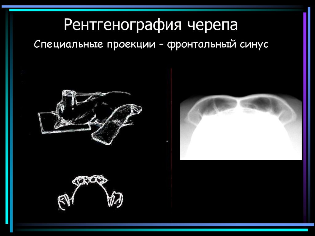 Рентгенография в 2 проекциях. Проекции рентгеновских снимков. Презентация на тему рентгенография. Рентген черепа в аксиальной проекции. Тангенциальная рентгенография черепа.