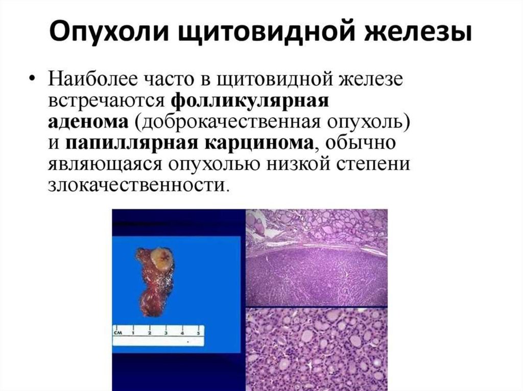 Аденома щитовидной железы. Опухоли щетовиднойжелезы. Опухоль щитовидной железы. Фолликулярная опухоль щитовидной. Злокачественные опухоли щитовидной железы.